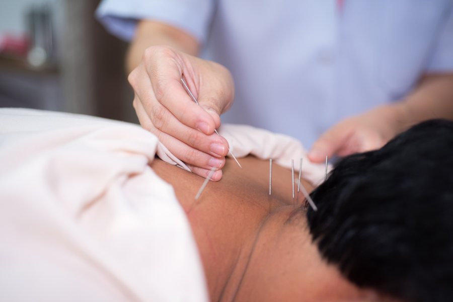 Dry needling applied to a patient's neck at Nuro Chiropractic in Brooklyn, NY
