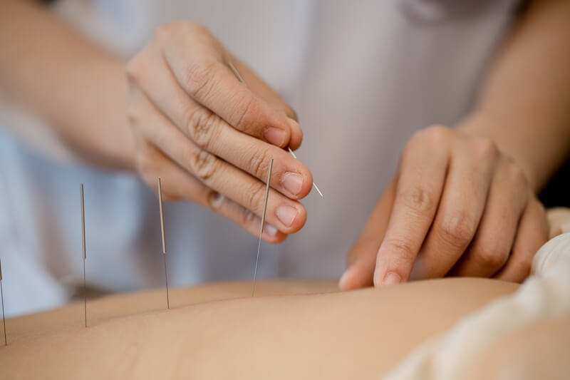 Acupuncture treatment applied to a patient's back